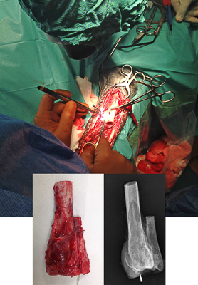 Transplantation of ipsilateral canine ulna as a vascularized bone graft for treatment of distal radial osteosarcoma